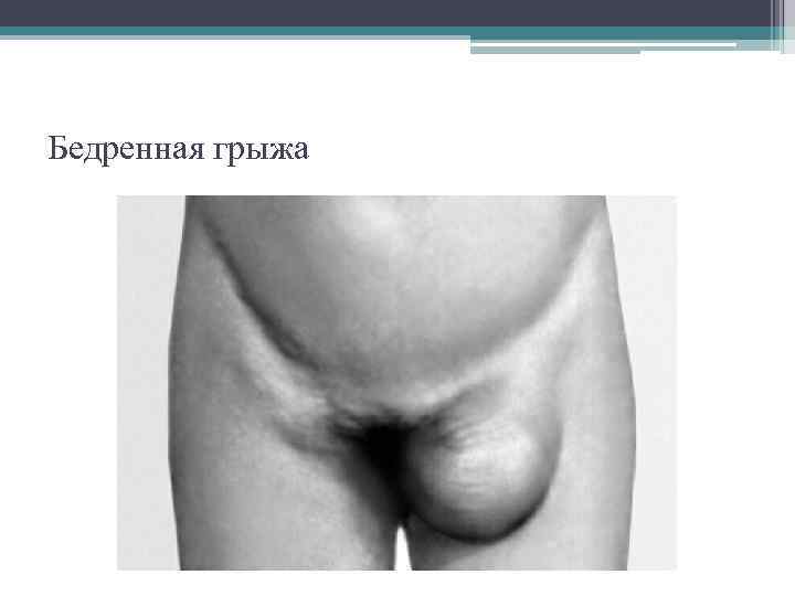 Бедренная грыжа 