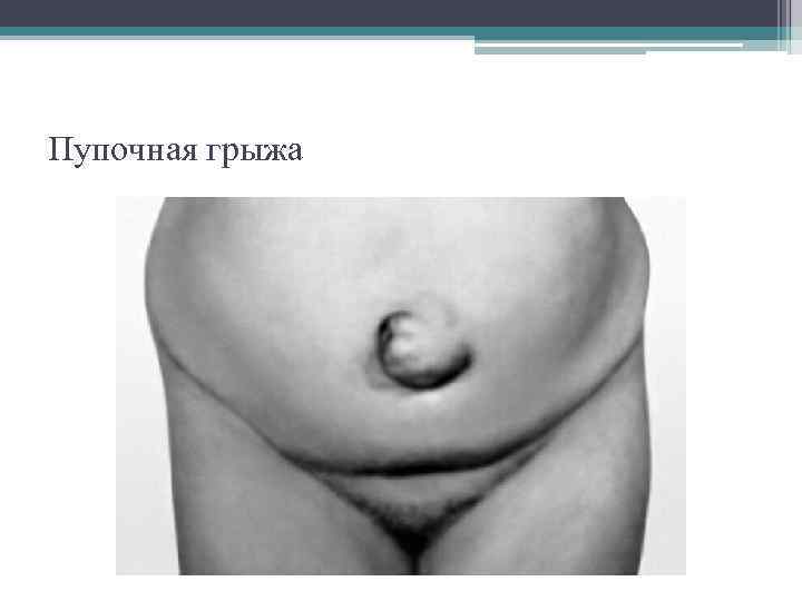 Пупочная грыжа 