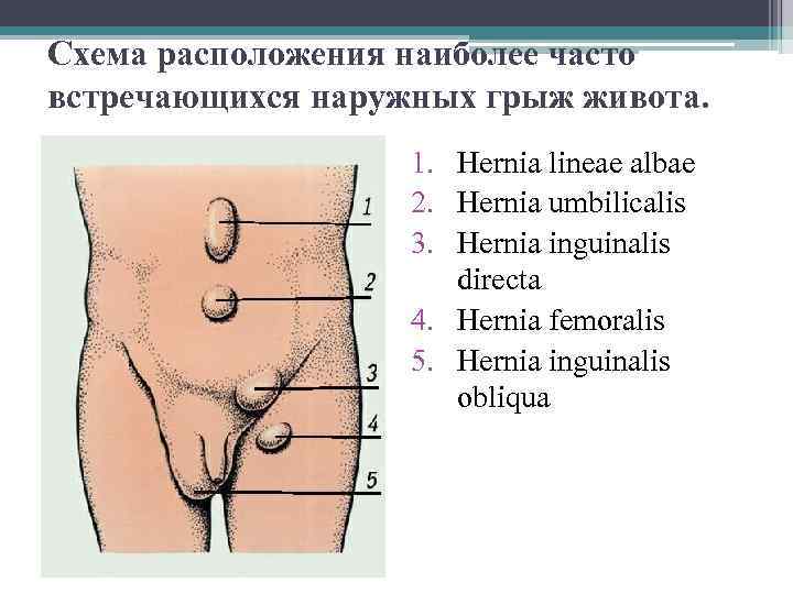 Схема расположения наиболее часто встречающихся наружных грыж живота. 1. Hernia lineae albae 2. Hernia