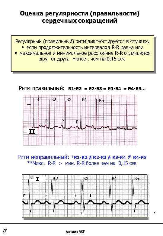 Оценка регулярности (правильности) сердечных сокращений Регулярный (правильный) ритм диагностируется в случаях, • если продолжительность