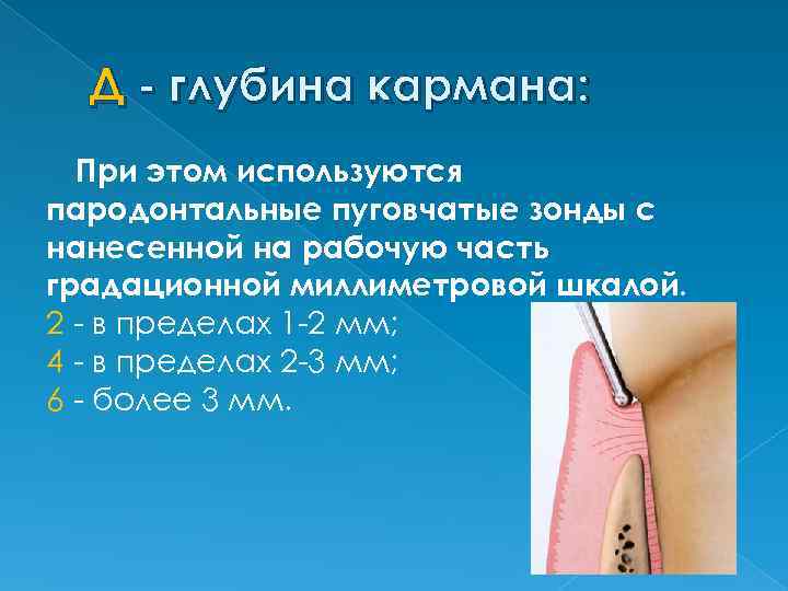 Д - глубина кармана: При этом используются пародонтальные пуговчатые зонды с нанесенной на рабочую