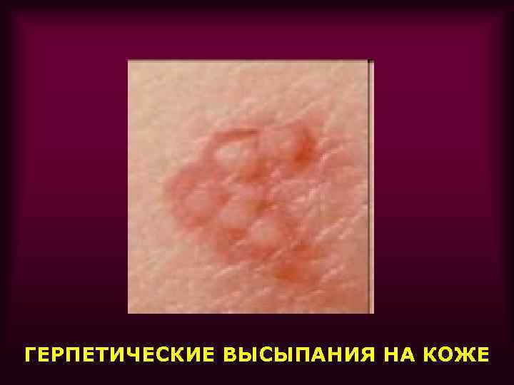 ГЕРПЕТИЧЕСКИЕ ВЫСЫПАНИЯ НА КОЖЕ 