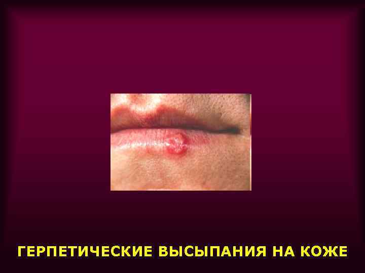 ГЕРПЕТИЧЕСКИЕ ВЫСЫПАНИЯ НА КОЖЕ 