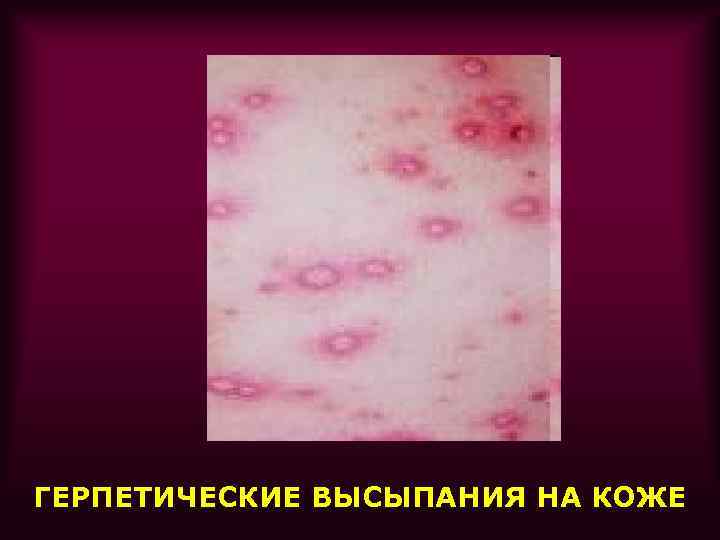 ГЕРПЕТИЧЕСКИЕ ВЫСЫПАНИЯ НА КОЖЕ 