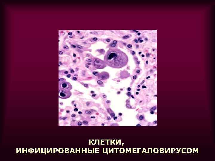   КЛЕТКИ, ИНФИЦИРОВАННЫЕ ЦИТОМЕГАЛОВИРУСОМ 