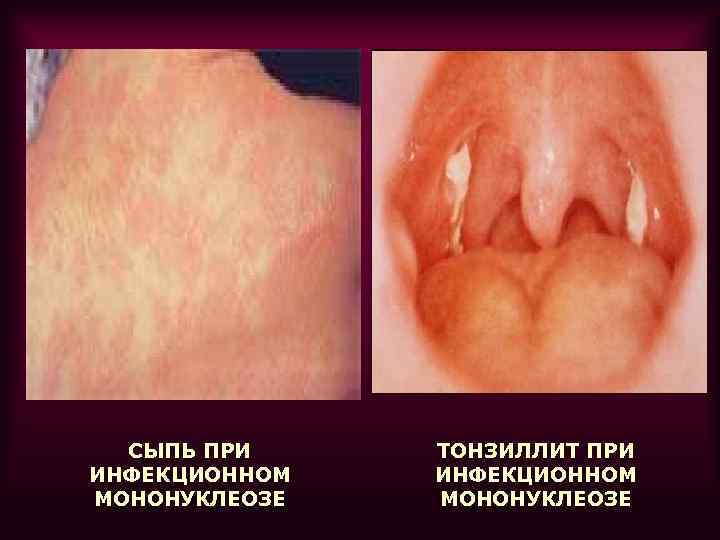  СЫПЬ ПРИ ТОНЗИЛЛИТ ПРИ ИНФЕКЦИОННОМ МОНОНУКЛЕОЗЕ 