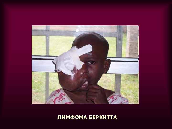 ЛИМФОМА БЕРКИТТА 