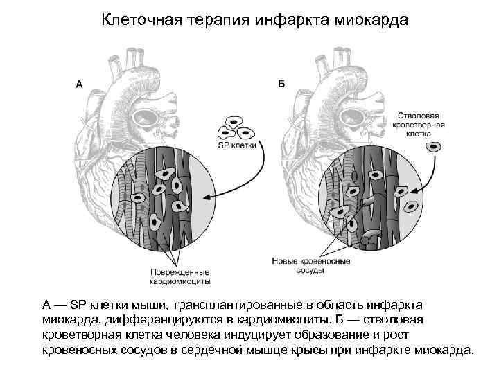 Клеточная терапия инфаркта миокарда А — SP клетки мыши, трансплантированные в область инфаркта миокарда,