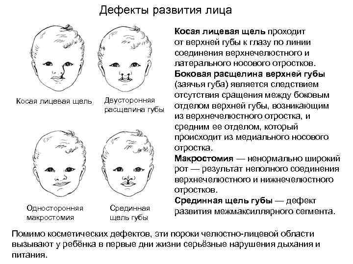 Дефекты развития лица Косая лицевая щель Односторонняя макростомия Двусторонняя расщелина губы Срединная щель губы