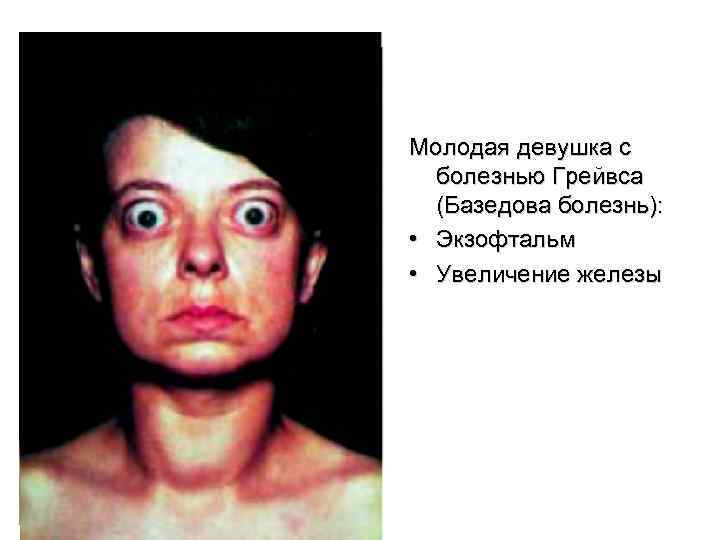 Молодая девушка с  болезнью Грейвса  (Базедова болезнь):  • Экзофтальм • Увеличение