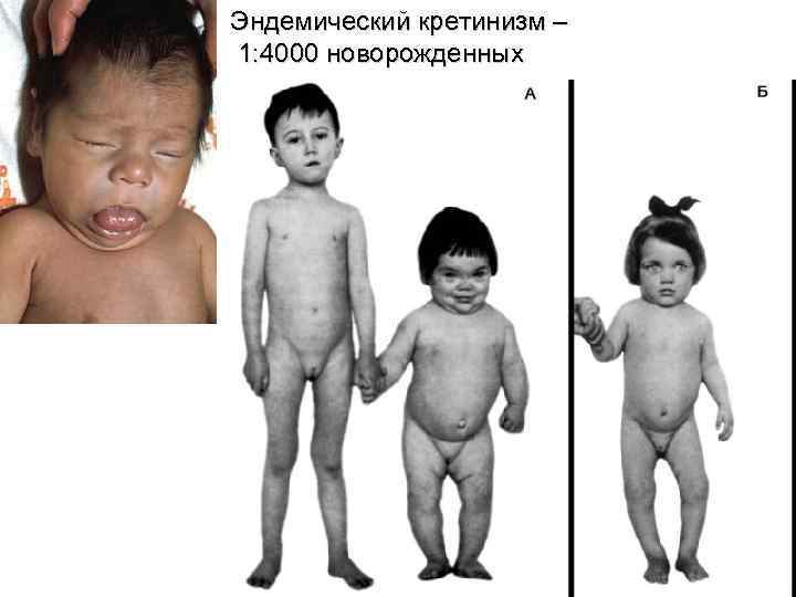 Эндемический кретинизм – 1: 4000 новорожденных 