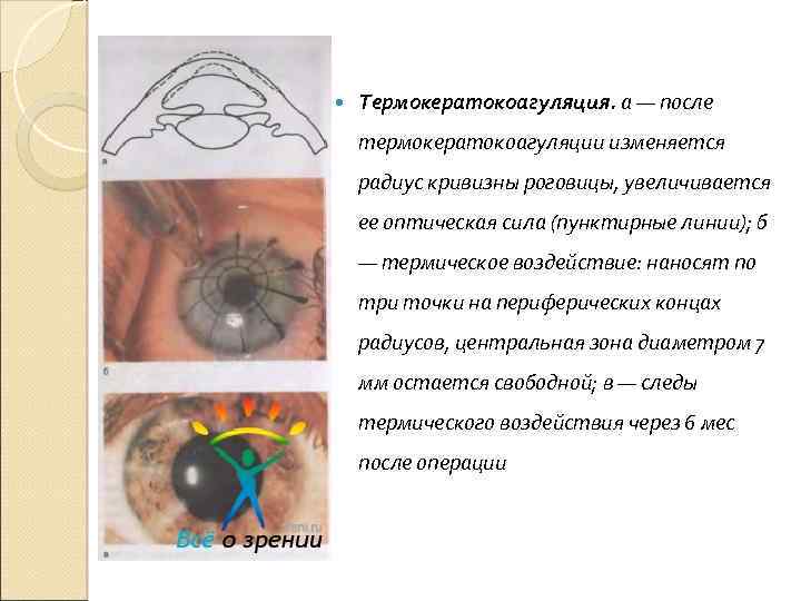 Радиус кривизны глаза