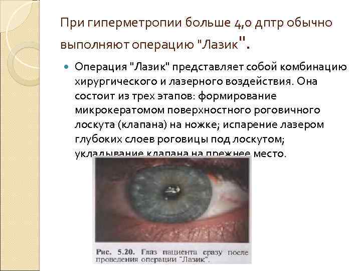 При гиперметропии больше 4, 0 дптр обычно выполняют операцию "Лазик". Операция "Лазик" представляет собой