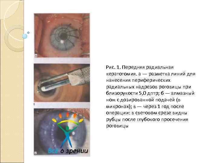 Рис. 1. Передняя радиальная кератотомия. а — разметка линий для нанесения периферических радиальных надрезов