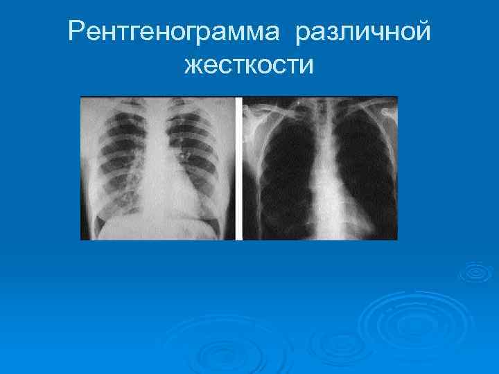 Рентгенограмма различной   жесткости 