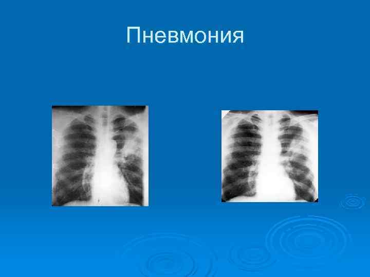 Пневмония 