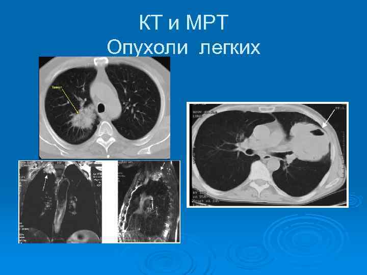   КТ и МРТ Опухоли легких 