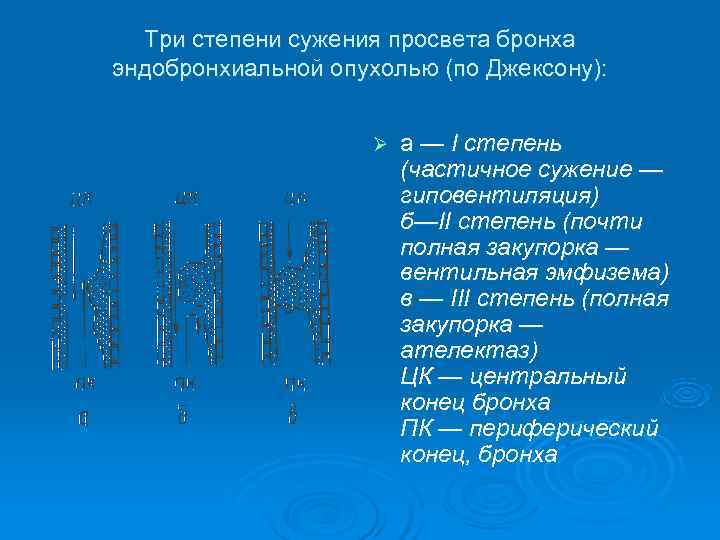  Три степени сужения просвета бронха эндобронхиальной опухолью (по Джексону):    