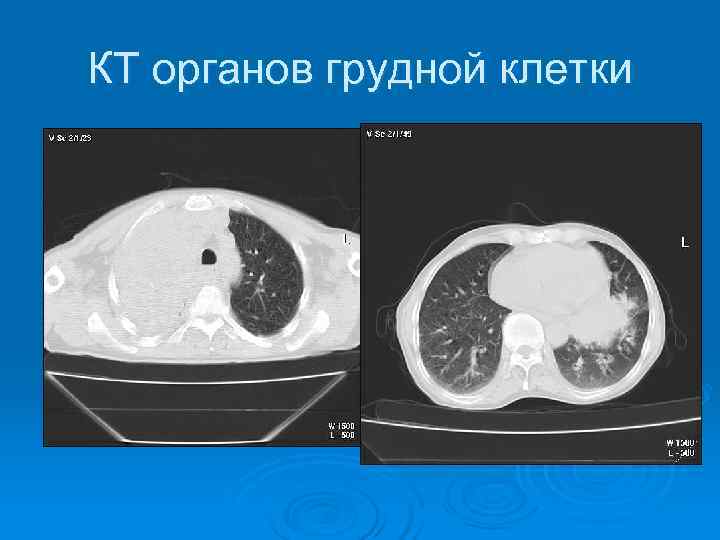 КТ органов грудной клетки 