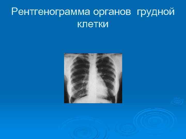 Рентгенограмма органов грудной   клетки 