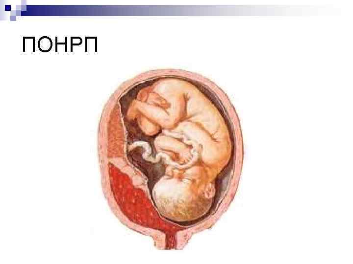 Понрп клиническая картина
