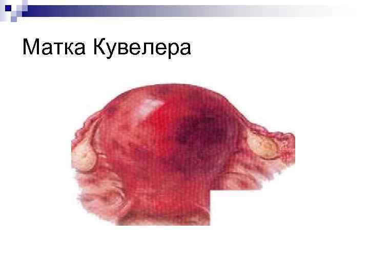 Матка Кувелера 