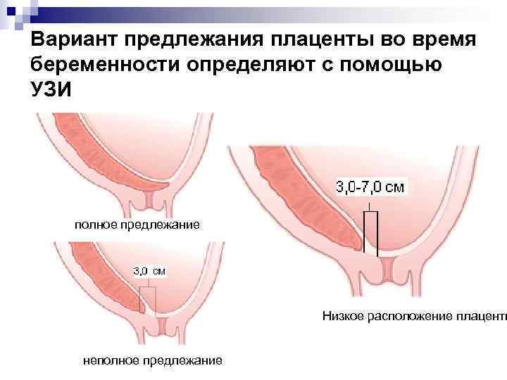 Вариант предлежания плаценты во время беременности определяют с помощью УЗИ  полное предлежание 