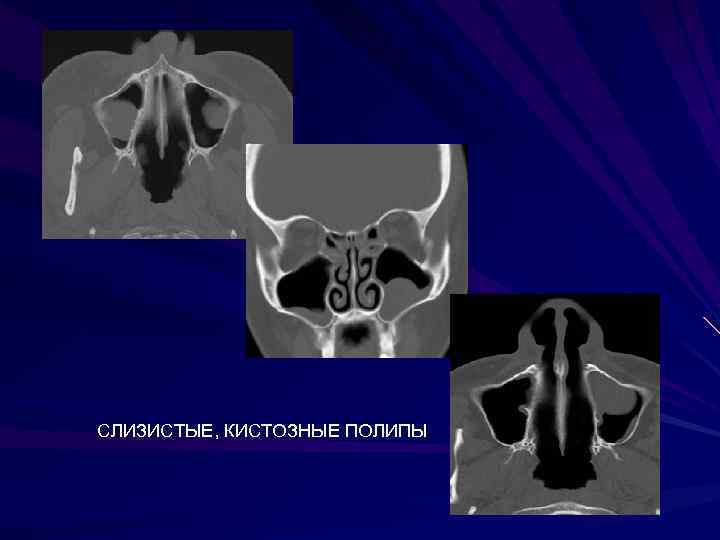 СЛИЗИСТЫЕ, КИСТОЗНЫЕ ПОЛИПЫ 
