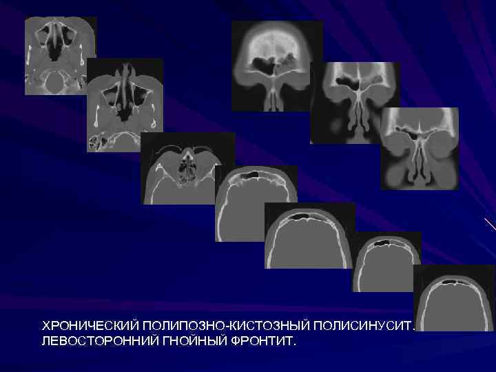 ХРОНИЧЕСКИЙ ПОЛИПОЗНО-КИСТОЗНЫЙ ПОЛИСИНУСИТ. ЛЕВОСТОРОННИЙ ГНОЙНЫЙ ФРОНТИТ. 