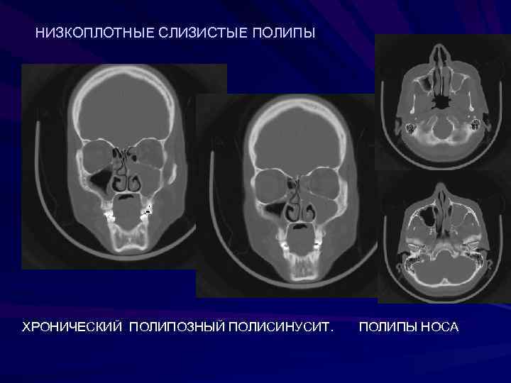  НИЗКОПЛОТНЫЕ СЛИЗИСТЫЕ ПОЛИПЫ ХРОНИЧЕСКИЙ ПОЛИПОЗНЫЙ ПОЛИСИНУСИТ.  ПОЛИПЫ НОСА 