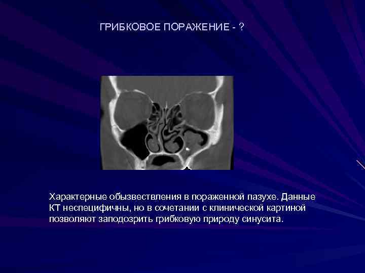   ГРИБКОВОЕ ПОРАЖЕНИЕ - ? Характерные обызвествления в пораженной пазухе. Данные КТ