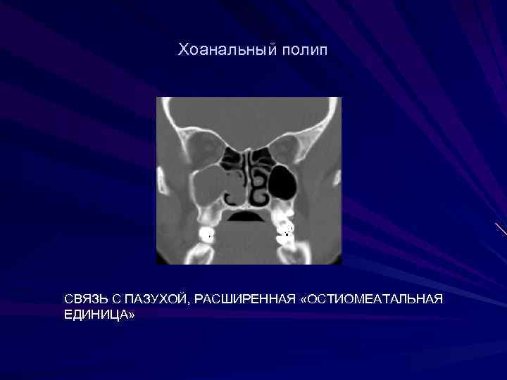    Хоанальный полип СВЯЗЬ С ПАЗУХОЙ, РАСШИРЕННАЯ «ОСТИОМЕАТАЛЬНАЯ ЕДИНИЦА» 