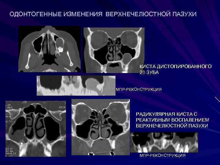 ОДОНТОГЕННЫЕ ИЗМЕНЕНИЯ ВЕРХНЕЧЕЛЮСТНОЙ ПАЗУХИ       КИСТА ДИСТОПИРОВАННОГО  