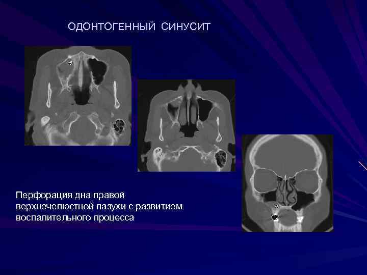 Правая верхнечелюстная пазуха где находится картинка