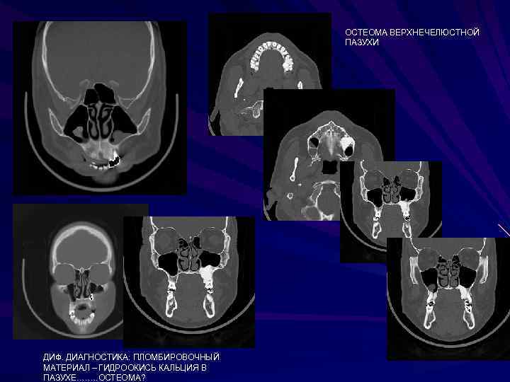       ОСТЕОМА ВЕРХНЕЧЕЛЮСТНОЙ      ПАЗУХИ