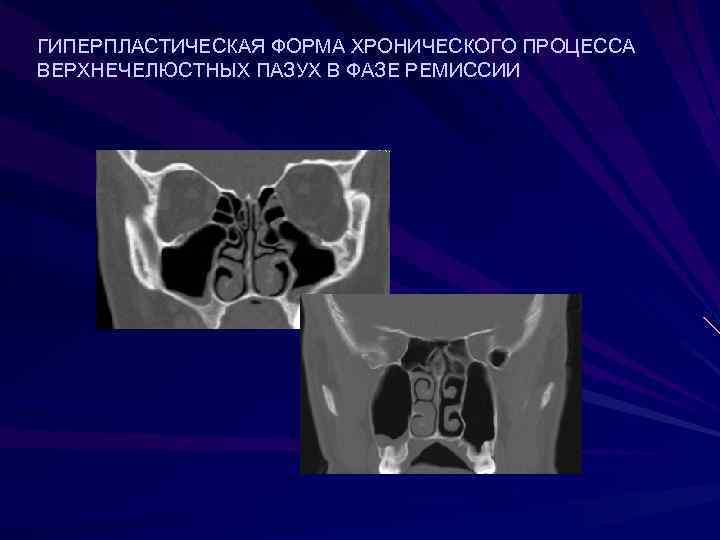 ГИПЕРПЛАСТИЧЕСКАЯ ФОРМА ХРОНИЧЕСКОГО ПРОЦЕССА ВЕРХНЕЧЕЛЮСТНЫХ ПАЗУХ В ФАЗЕ РЕМИССИИ 