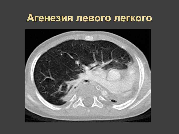 Агенезия левого легкого 