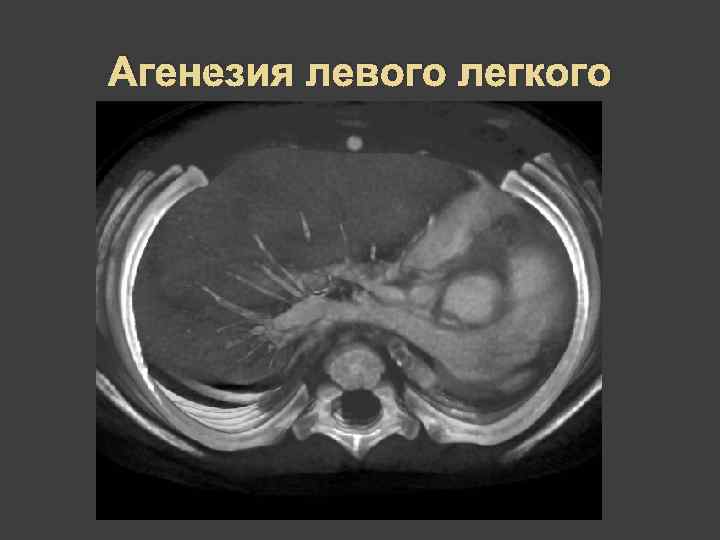 Агенезия левого легкого 