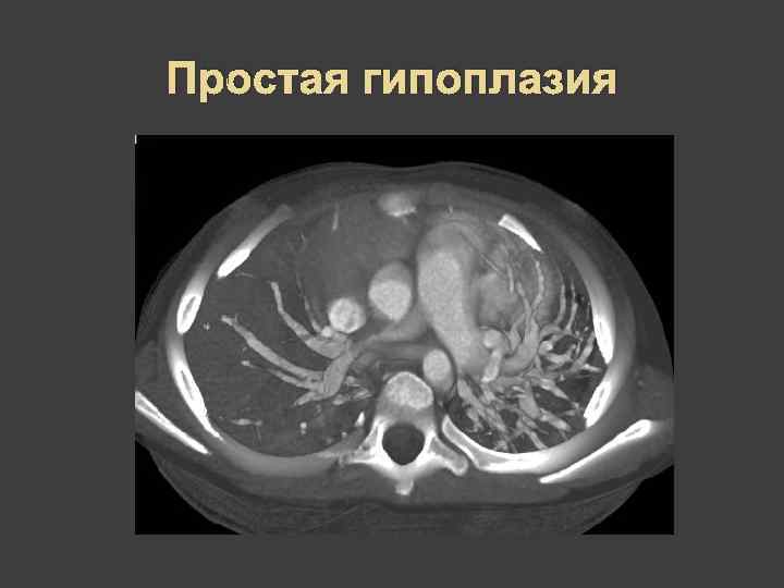 Простая гипоплазия 