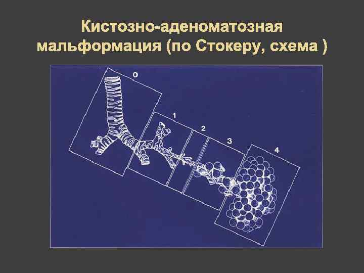 Реактивная деформация легочного рисунка