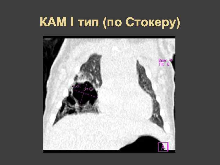 КАМ I тип (по Стокеру) 