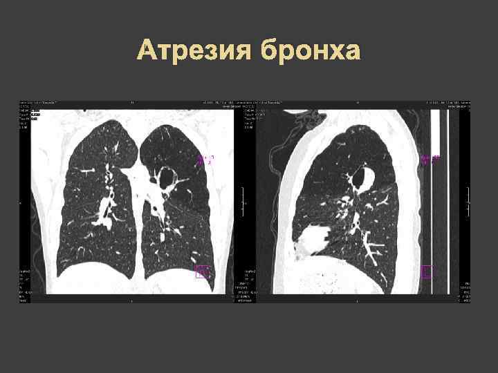 Что такое абстракция бронхов