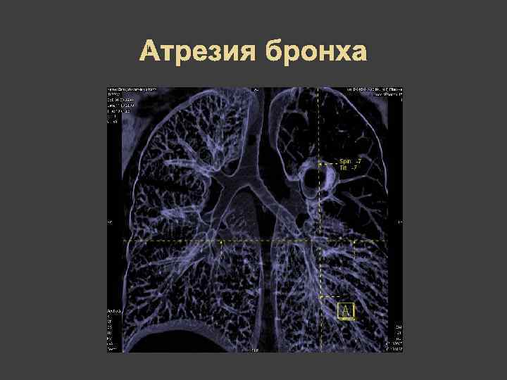 Атрезия бронха 