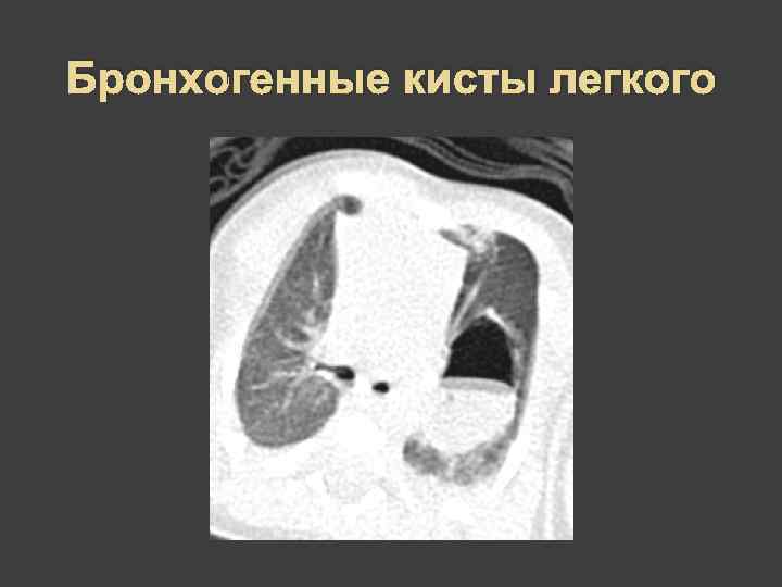 Бронхогенные кисты легкого 