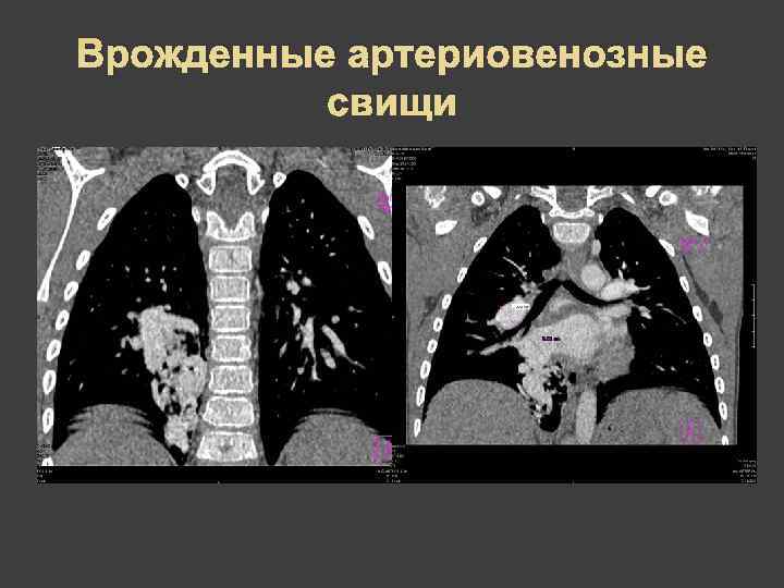 Врожденные артериовенозные  свищи 