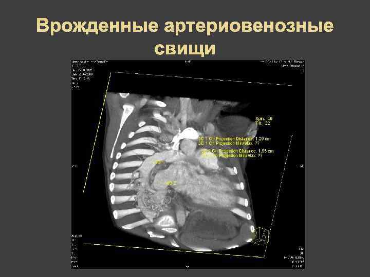 Врожденные артериовенозные  свищи 