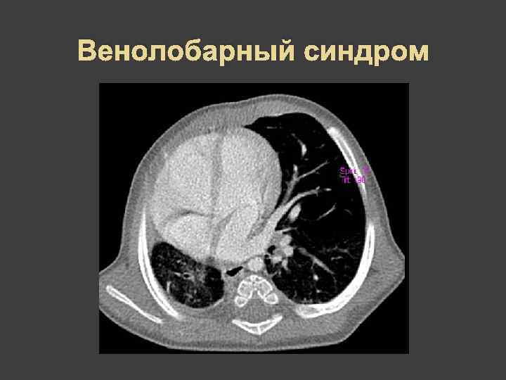 Венолобарный синдром 
