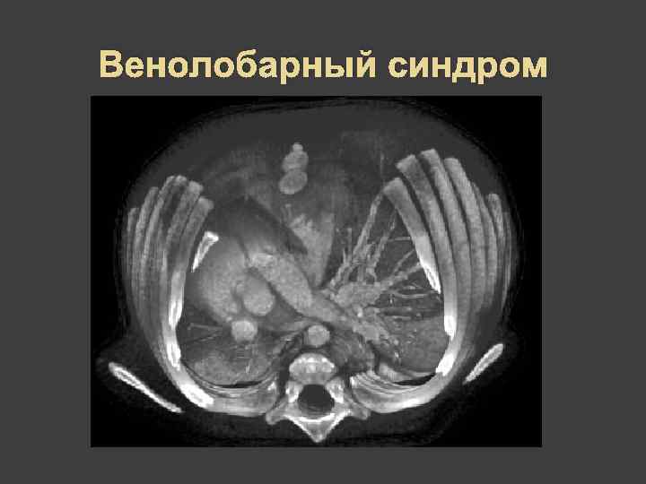 Венолобарный синдром 