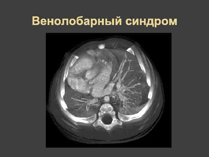 Венолобарный синдром 