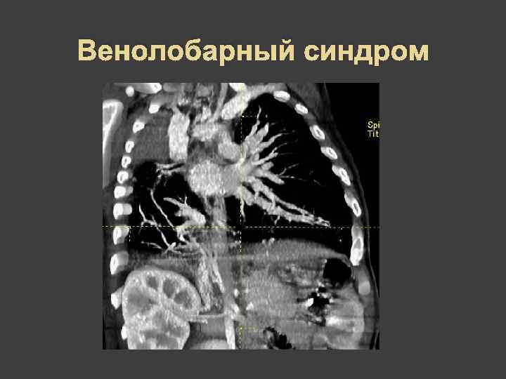 Венолобарный синдром 
